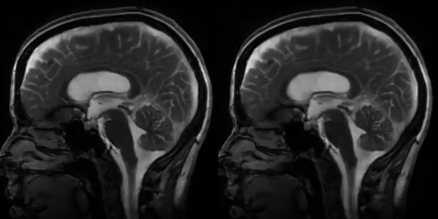 Nieuwe MRI-methode toont piepkleine breinbewegingen