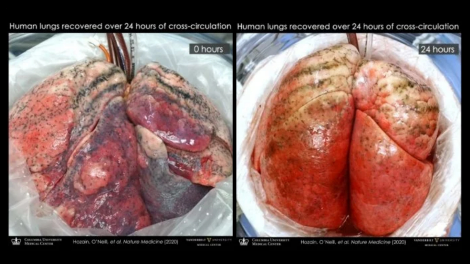 Donorlongen herstellen in 24 uur door nieuwe bewaarmethode, koppelen aan een varken
