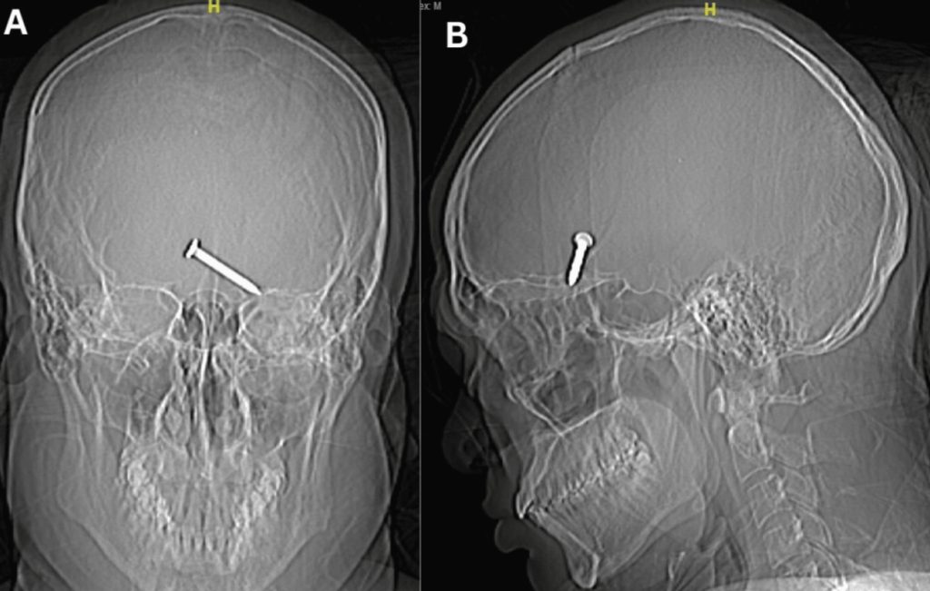 Röntgenfoto van de voorkant (A) en zijkant (B) laten zien dat de spijker ook de hersenen is binnengedrongen.