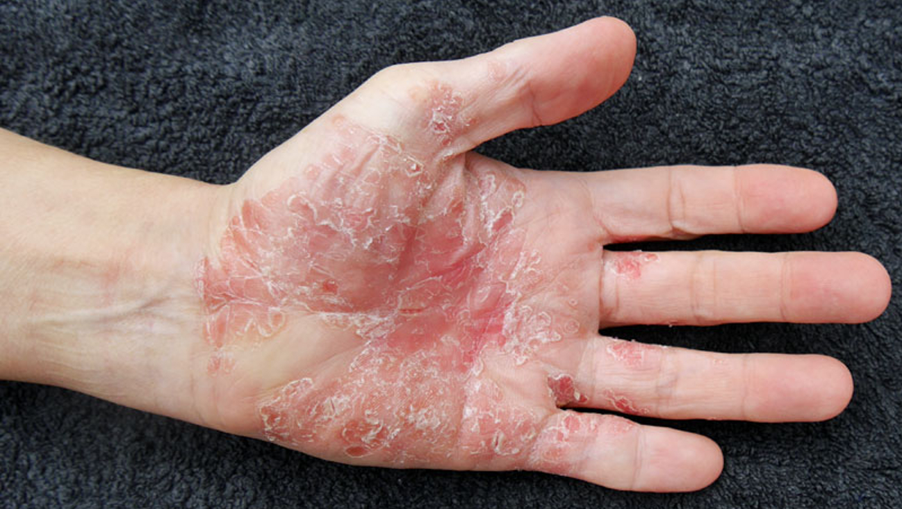 handpalm met psoriasis, droge schilfers