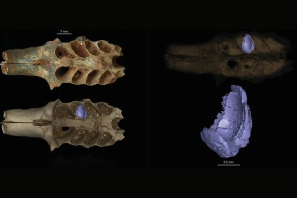 Een CT-scan van een kaakbot met een bijennest (paars) in een van de tandkassen