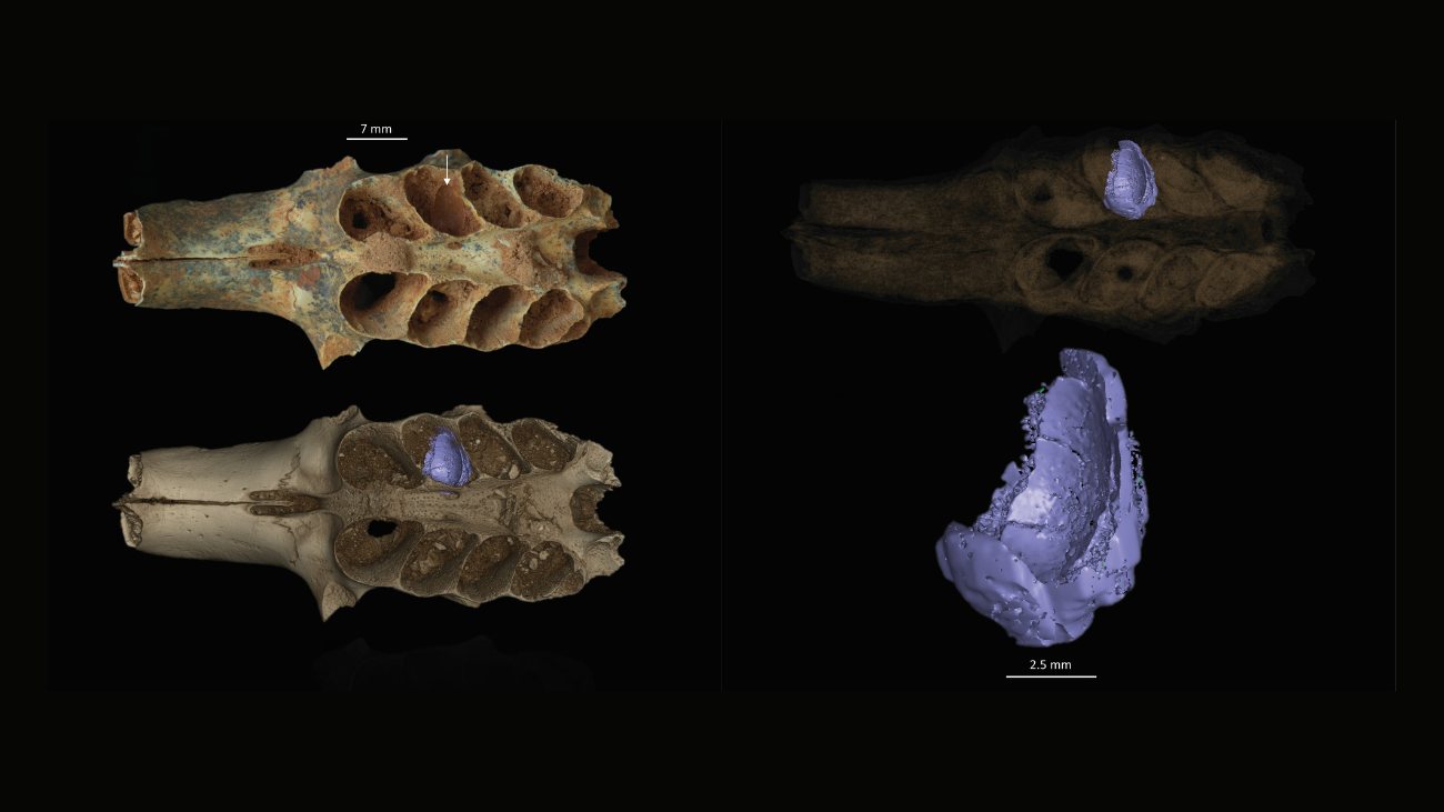 Een CT-scan van een kaakbot met een bijennest (paars) in een van de tandkassen